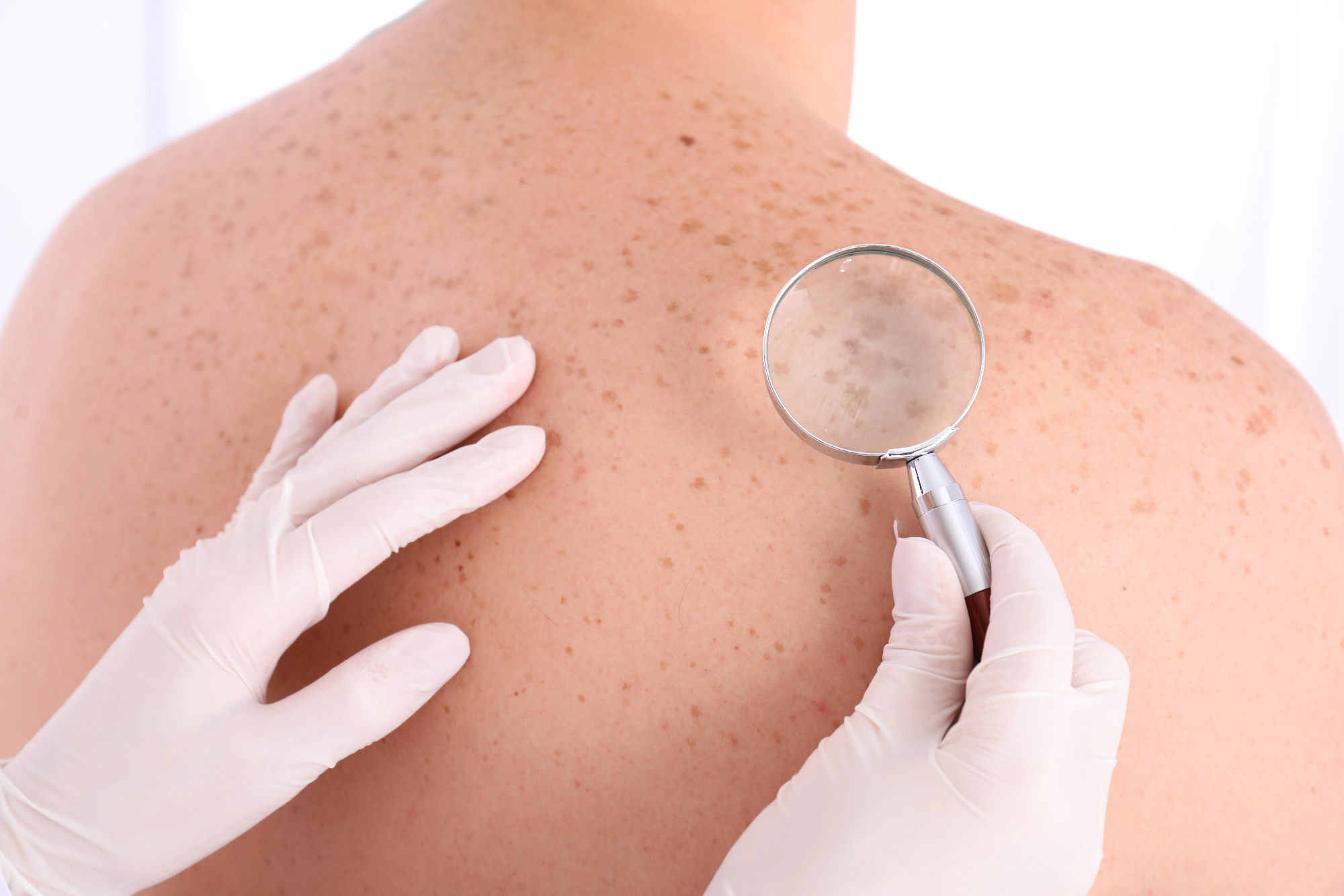 Dermatolog mi je lahko pomagal